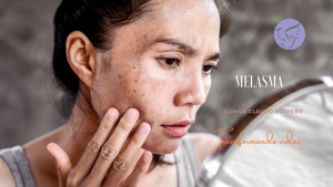 Melasma