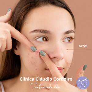 Tratamento de acne