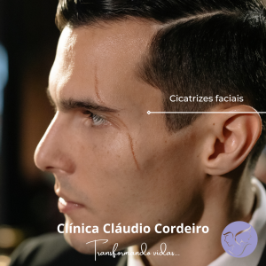 Cicatrizes e queloides no rosto