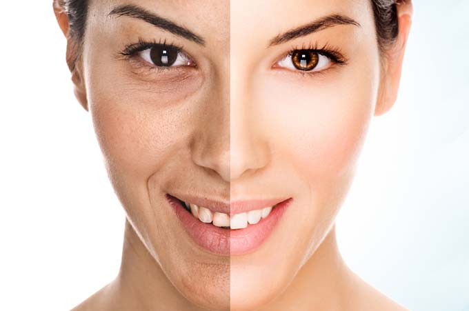 Manchas faciais Melasma Manchas faciais Melasma