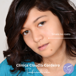 Remoção de sinais no rosto e no pescoço