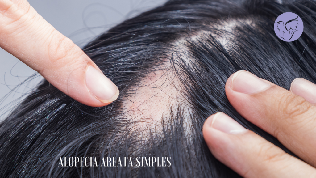 Alopecia areata