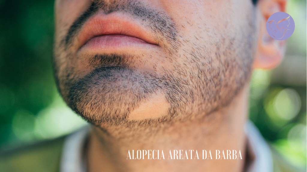 Alopecia areata da barba