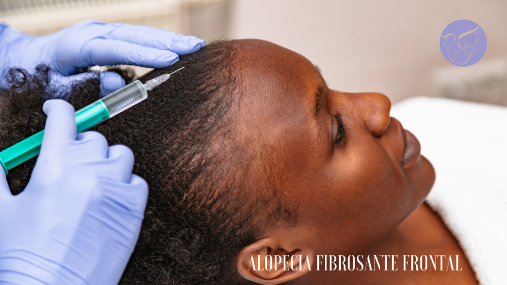 Alopecia fibrosante frontal